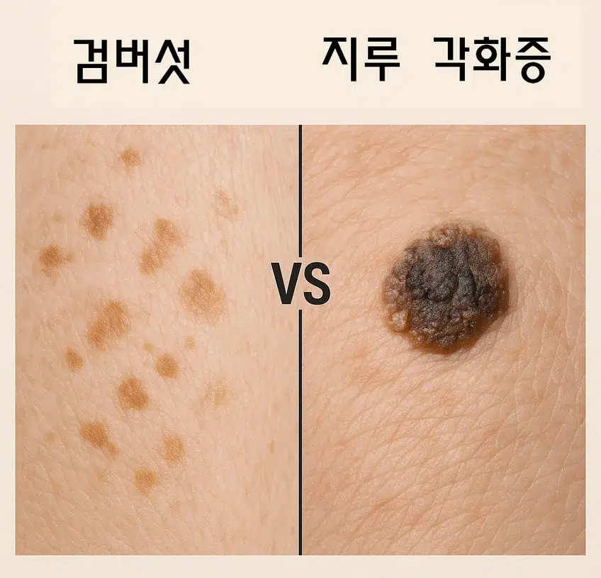 노인성 반점과 지루 각화증의 피부 병변을 비교한 이미지. 왼쪽은 평평하고 갈색의 노인성 반점, 오른쪽은 융기된 사마귀 형태의 지루 각화증 모습.